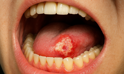oral cancer