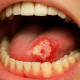 oral cancer
